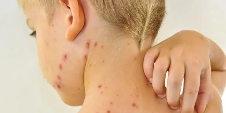 56 деца са заболели от варицела за седмица в Монтанско