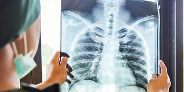 Нов случай на туберкулоза в Монтана: Здравните власти съобщават за диагноза при един човек - Montana Live TV